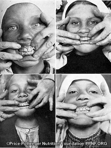 Isolated Swiss Children No Tooth Decay